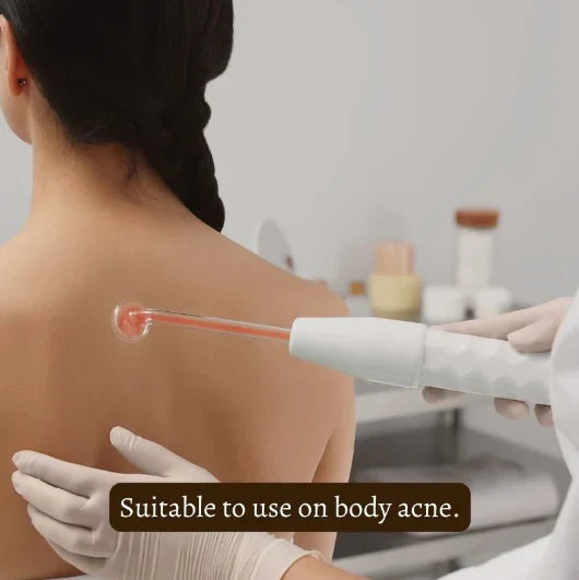 SkinVibe™ Clinical High Frequency Wand