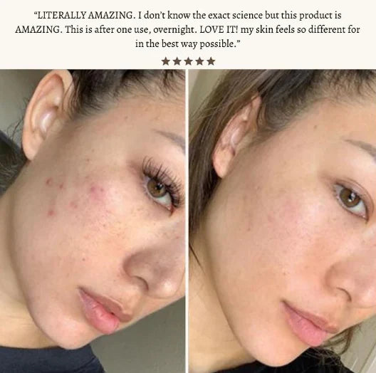 SkinVibe™ Clinical High Frequency Wand