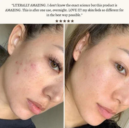 SkinVibe™ Clinical High Frequency Wand