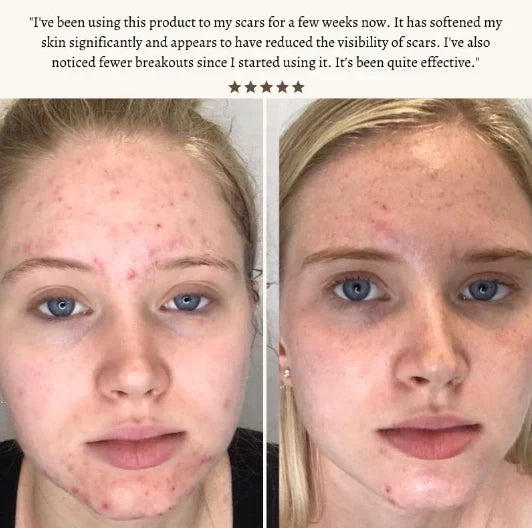 SkinVibe™ Clinical High Frequency Wand