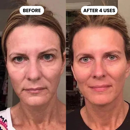 SkinVibe™ Clinical High Frequency Wand